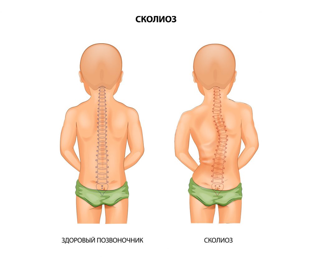 Сколиоз
