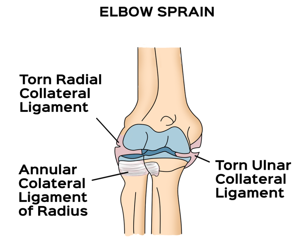 ELBOW SPRAIN