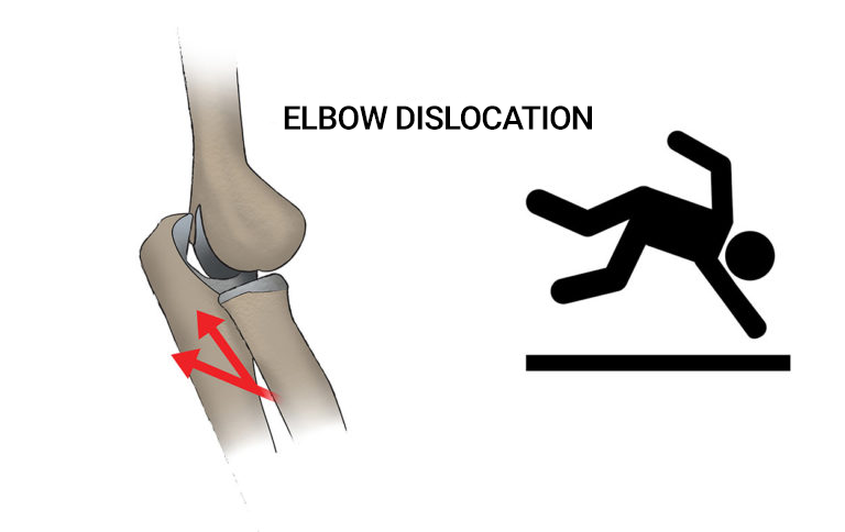 Elbow dislocation