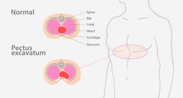 Funnel chest Funnel chest