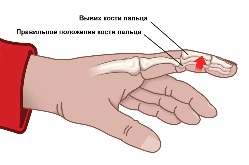 ВЫВИХ ПАЛЬЦА