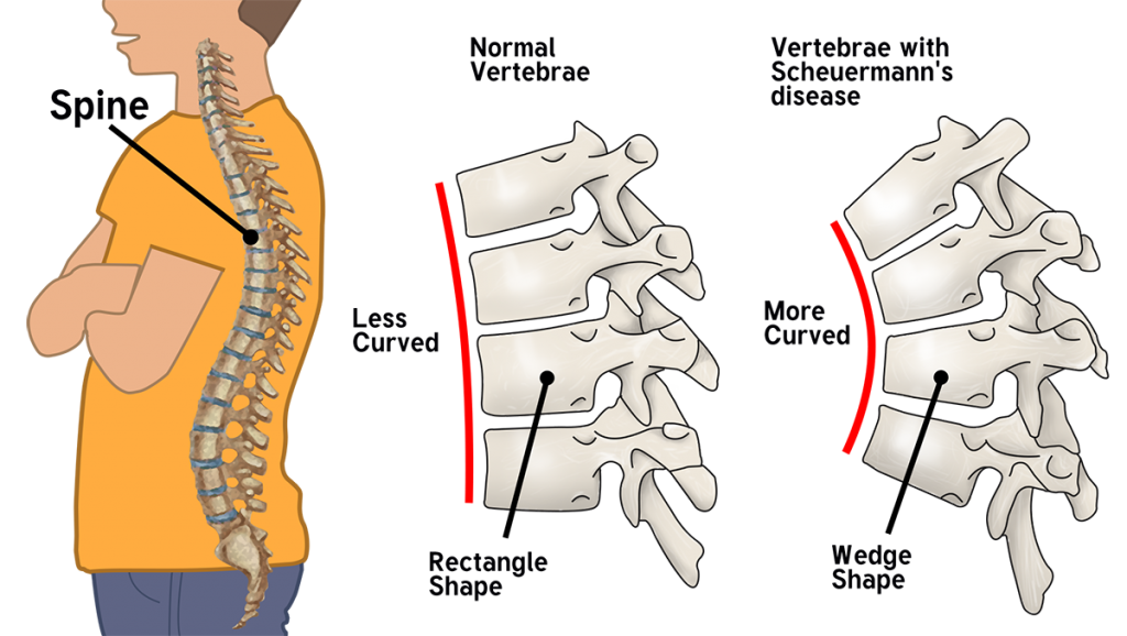 Scheuermann’s Disease