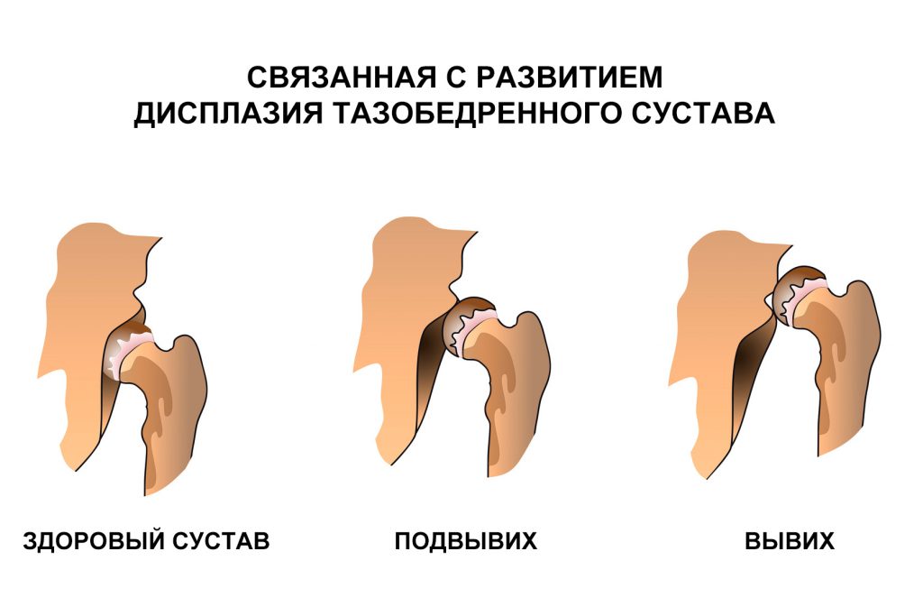 Врождённый вывих бедра